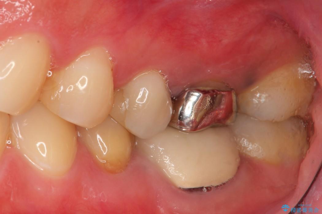 代女性 深い位置まで虫歯になった歯を残す 治療例 六本木河野歯科クリニック