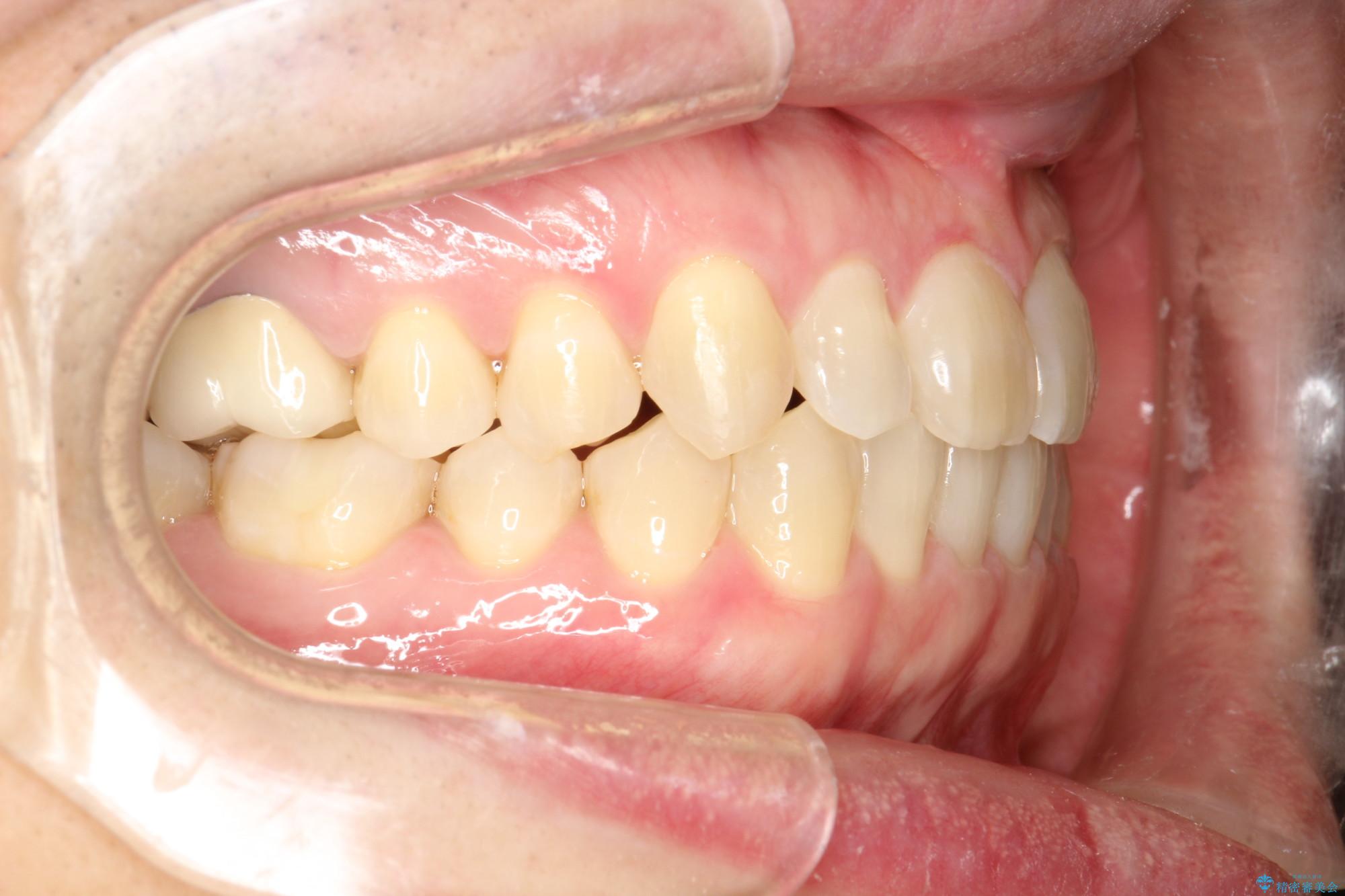 40代男性 インビザラインで前歯の隙間を閉じる 治療後