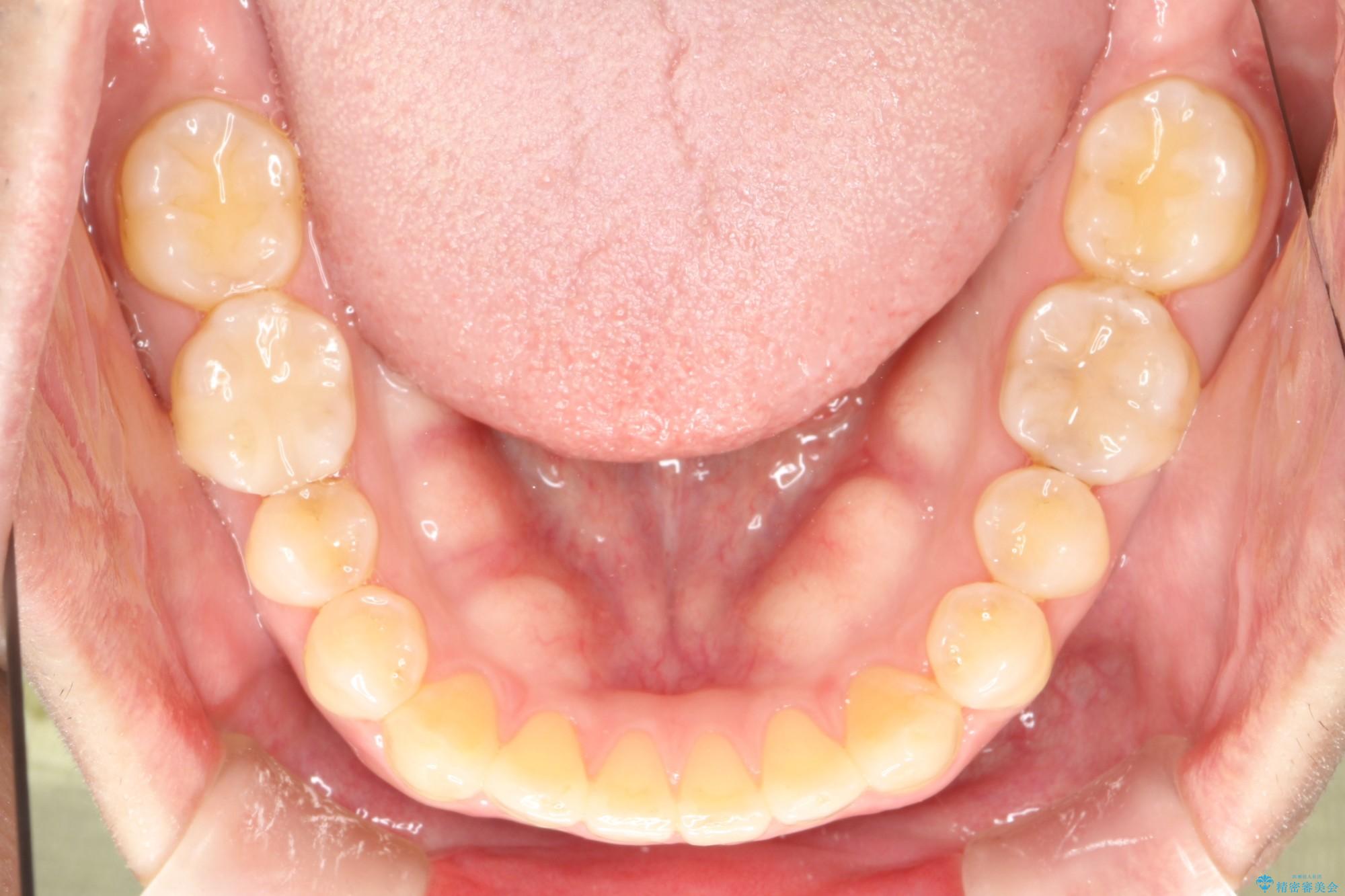 40代男性 インビザラインで前歯の隙間を閉じる 治療後