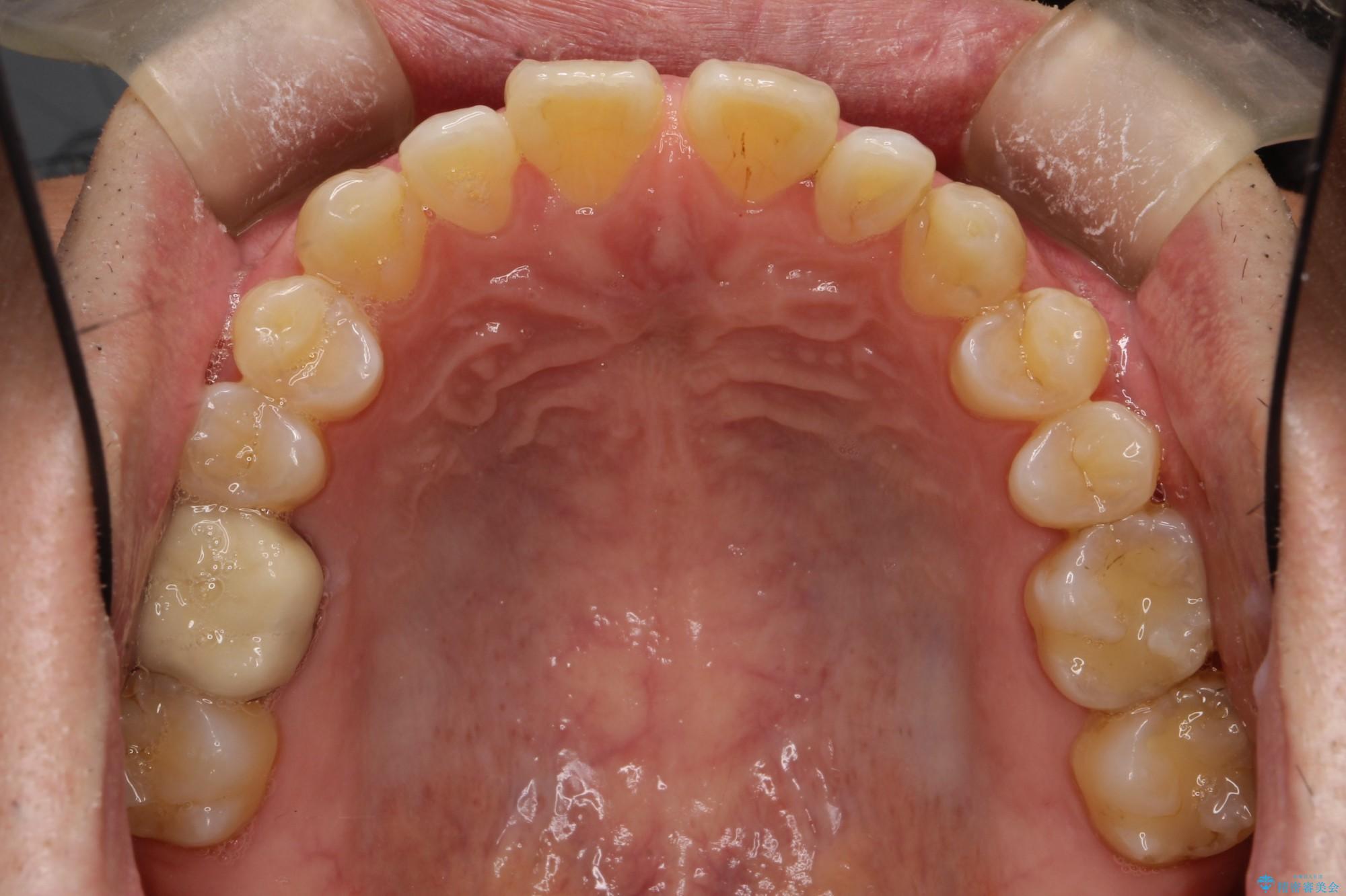 40代男性 インビザラインで前歯の隙間を閉じる 治療前