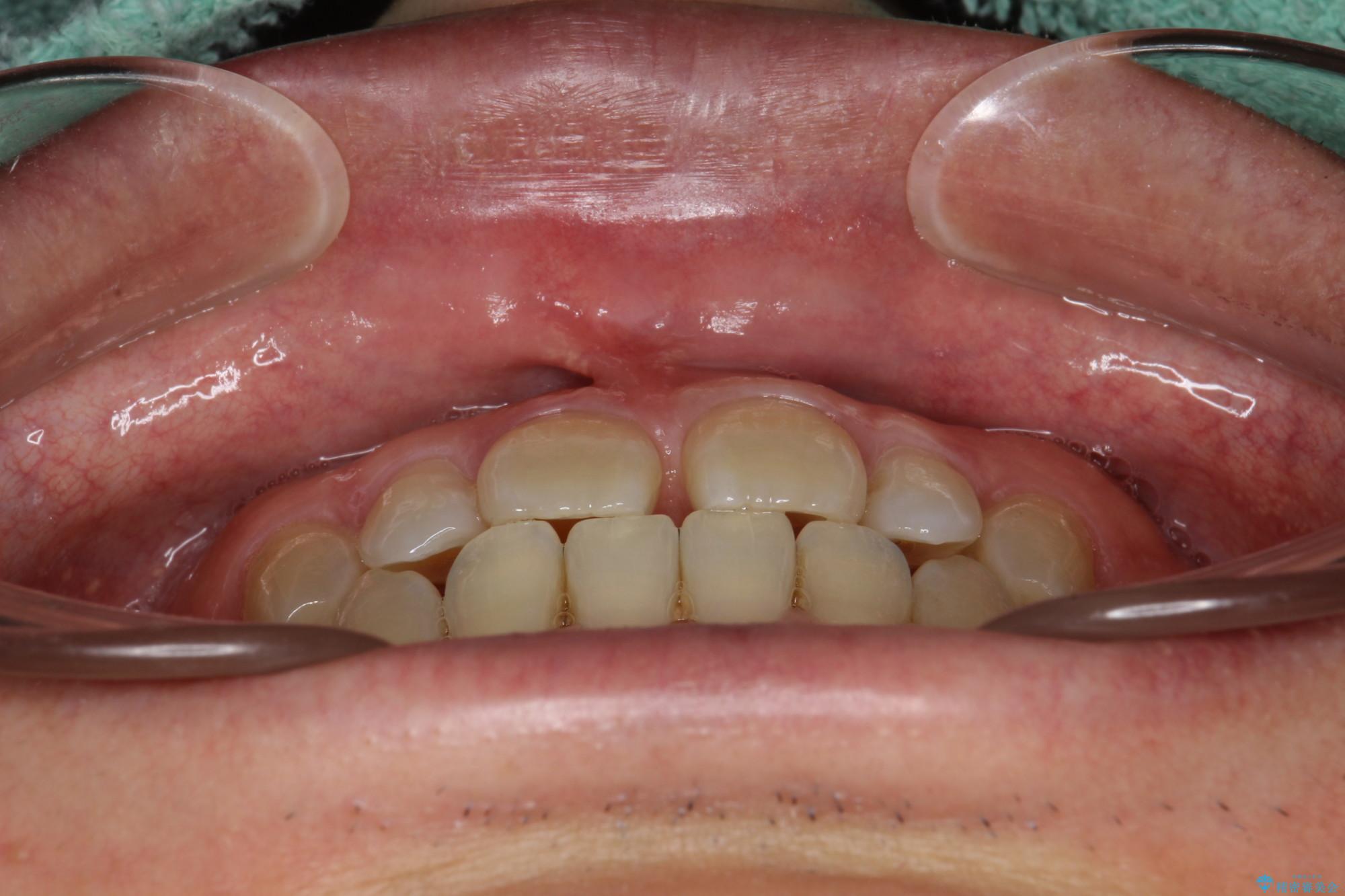 40代男性 インビザラインで前歯の隙間を閉じる 治療前